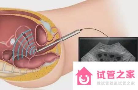 為什么高齡試管很難一次成功？這6點一定要提前了解