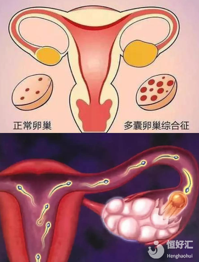 多囊*巢做試管究竟是好是壞？看完你就知道了