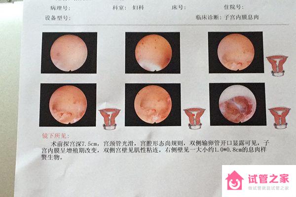 重慶附一院宮腔鏡費用看情況，2023需做人流至少兩千起