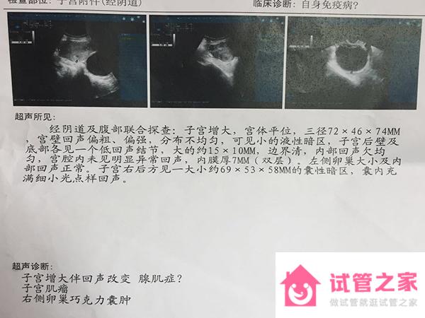 左側(cè)*巢有5cm巧克力囊腫嚴重嗎？可以保守治療嗎？