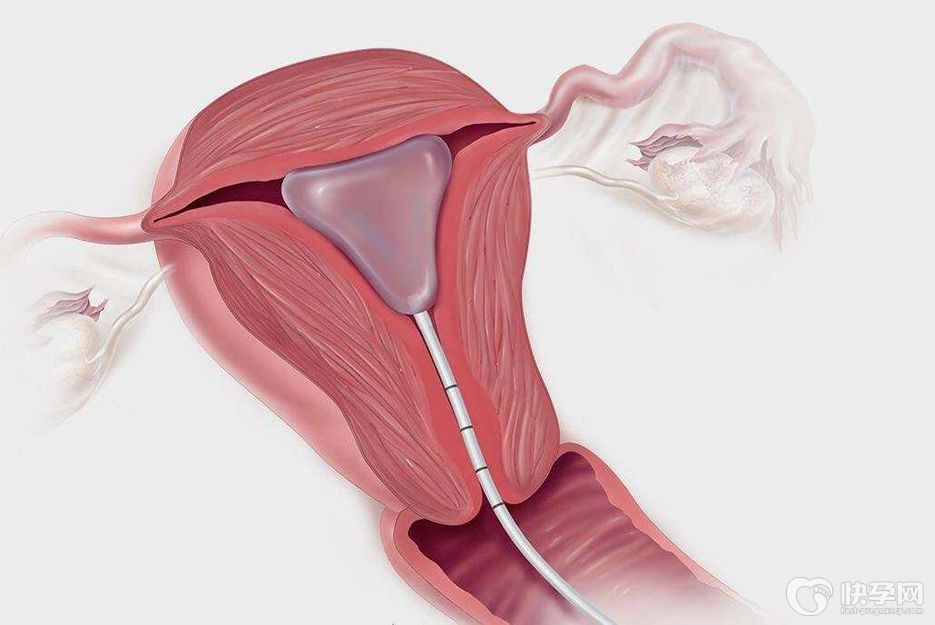 答疑：宮腔中度粘連做試管嬰兒成功率，不治療可能只有10%