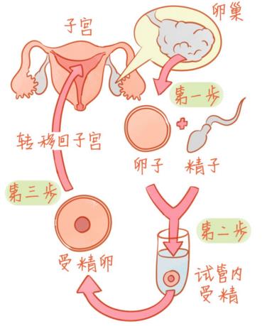 試管嬰兒多少錢和差異大主要原因