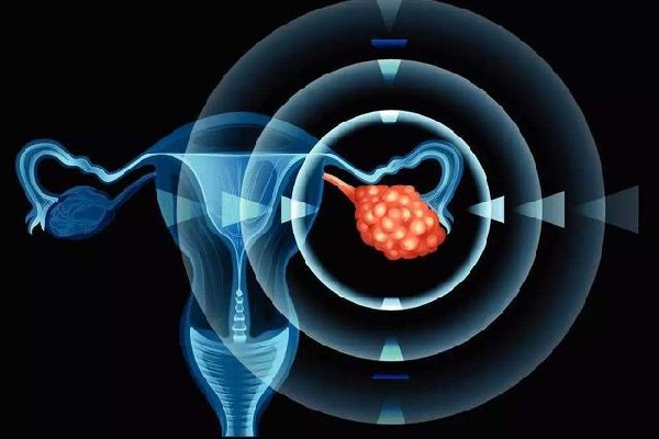 患上*巢癌身體會(huì)怎么樣？