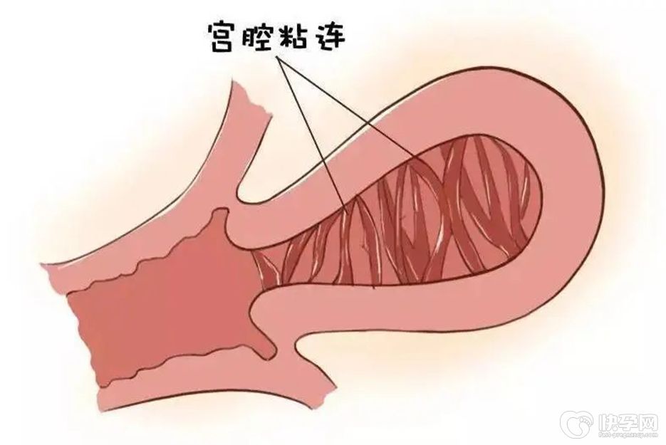 重度宮腔粘連術(shù)后試管成功率解讀，取決于宮腔環(huán)境恢復(fù)情況 ...