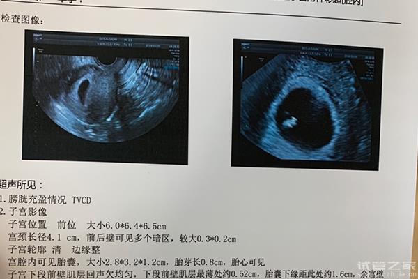 懷孕7周胎芽8mm大小判斷男女方法在這，看性別小技巧真準