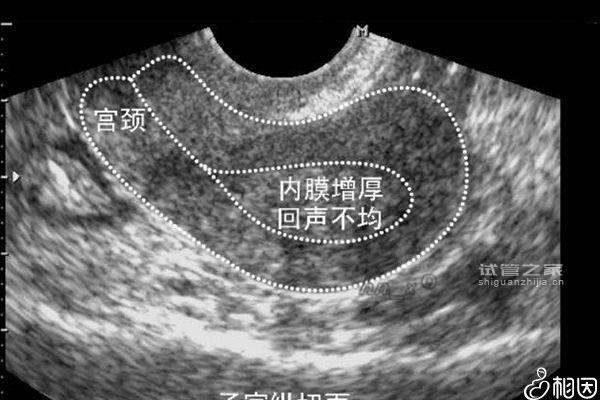 內(nèi)膜9c移植囊胚成功率沒(méi)你想象的高，好不好看完這篇就知道