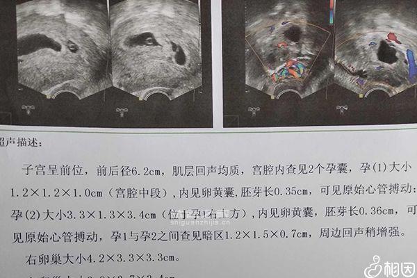 別糾結(jié)試管二超是陰超還是腹超了，先看會不會導(dǎo)致流產(chǎn)再說 ...