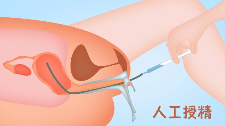 哪些患者適合做人工授精呢？