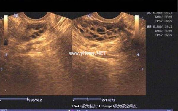 右側(cè)*巢有10個(gè)*泡正常嗎?，最大的只有8mm算多囊嗎？