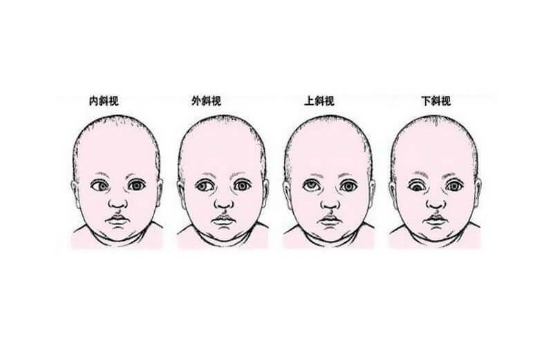 嬰兒對眼兩大處理辦法，查明原因“對癥下藥”是關鍵