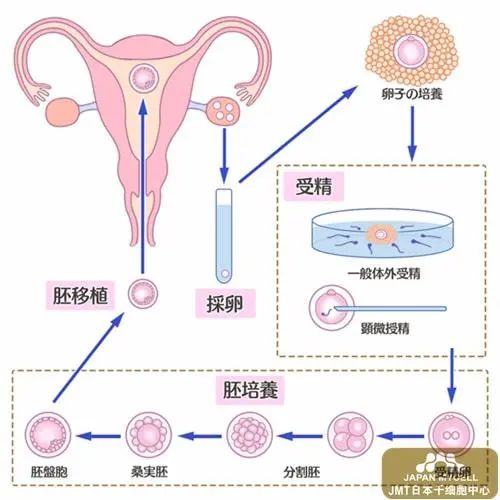 復(fù)發(fā)性流產(chǎn)患者適合選擇輔助生殖技術(shù)助孕嗎？