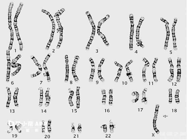 揭秘21號染色體隨體柄增長臨床意義，要想生子必須做試管