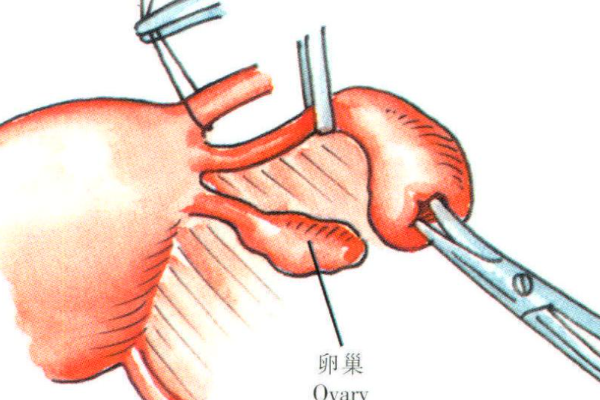 這就是輸*管微創(chuàng)手術(shù)，一探了解手術(shù)全程！