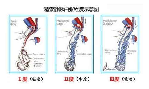 什么是精索靜脈曲張？精索靜脈曲張的原因有哪些？精索靜脈曲張該如何治療？精索靜脈曲 ...