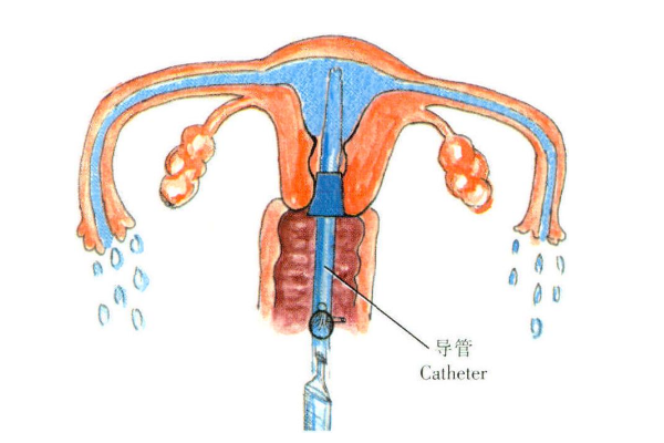 輸*管疏通手術(shù)費(fèi)用相差大，私立醫(yī)院比公立醫(yī)院費(fèi)用更高