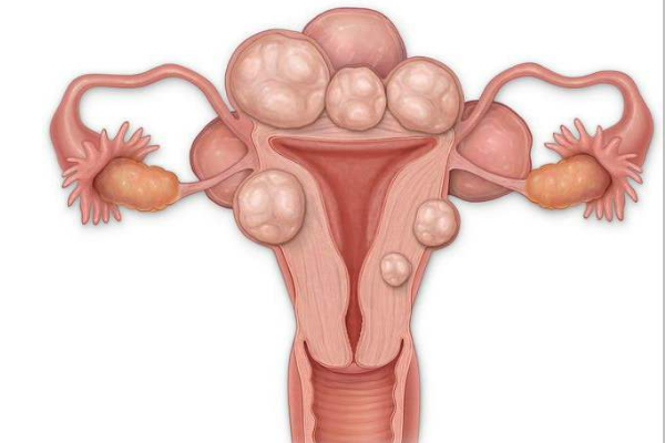 子宮肌瘤通常沒(méi)有明顯不適，常見(jiàn)的治療方式有這三種