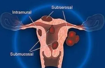 子宮肌瘤常見癥狀和前兆是什么？子宮肌瘤對試管嬰兒有什么影響？子宮肌瘤會先手術(shù)再做 ...