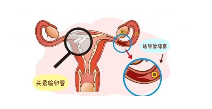 輸卵管粘連做什么檢查可以查出來