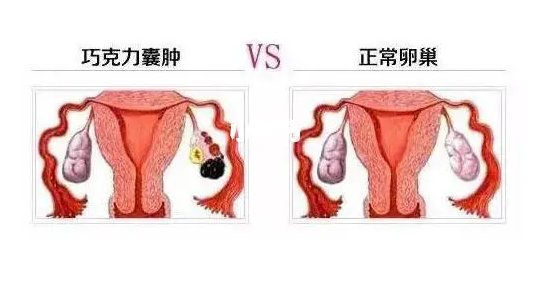 卵巢囊腫在哪個部位：卵巢囊腫在哪個部位??