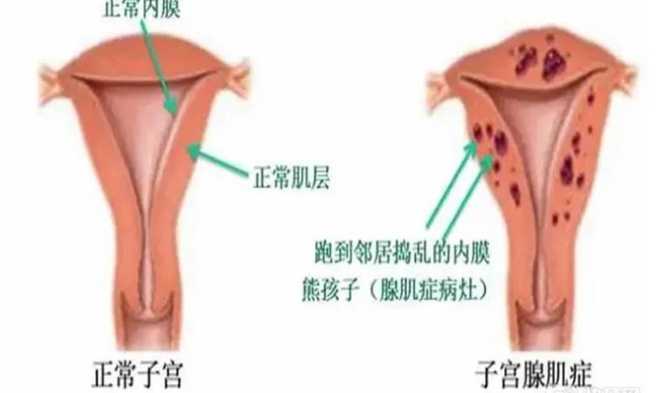 子宮腺肌癥移植前如何提高成功率？附試管提高成功率方法？ ...