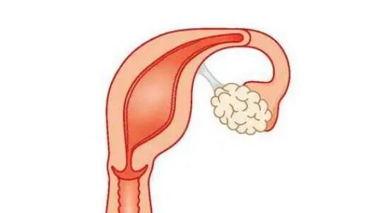 單角子宮會(huì)造成胎兒畸形嗎費(fèi)用多少錢？