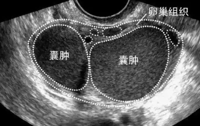 巧克力囊腫是什么??？卵巢異位囊腫如何治療？治療巧克力囊腫必須手術(shù)嗎？ ...