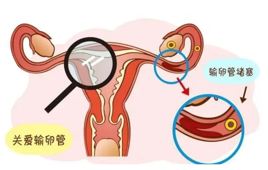 輸卵管堵塞也會導(dǎo)致懷孕難？輸卵管的檢查方法有哪些？三種檢查方法中那個是最最多和最 ...