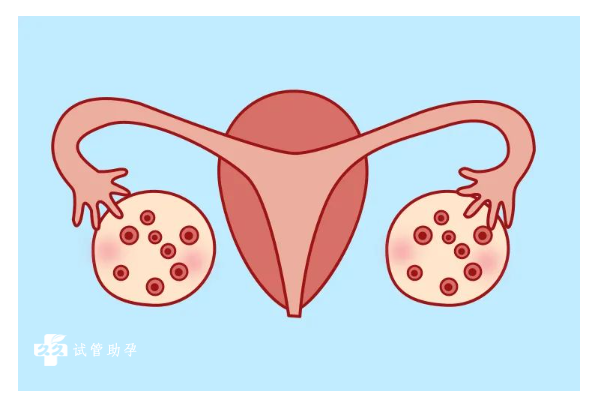 患有多囊卵巢能做試管嗎，這些方法可提高受孕率
