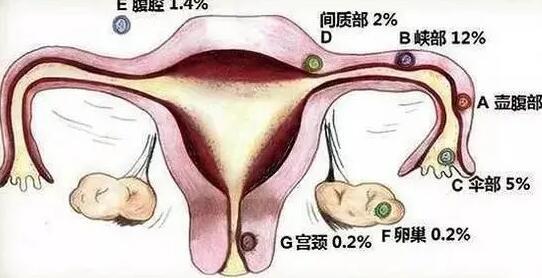 宮外孕患者做試管效果好嗎一共多少錢？