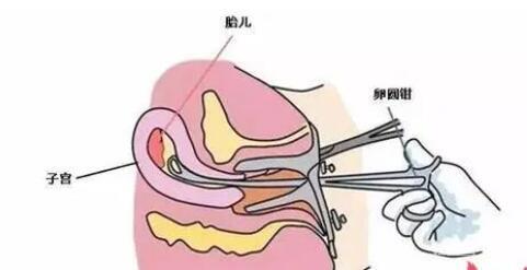 宮腔粘連術(shù)后多久可以試管移植凍胚？