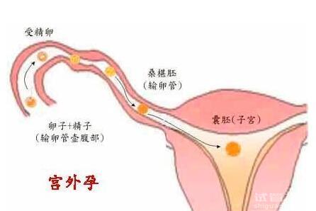 宮外孕后做試管還容易宮外孕嗎？試管費用多少錢？