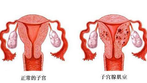 2024子宮腺肌癥可以做試管嗎多少錢？