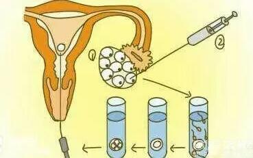 2024輸卵管結(jié)扎了還可以做試管嬰兒嗎多少錢？