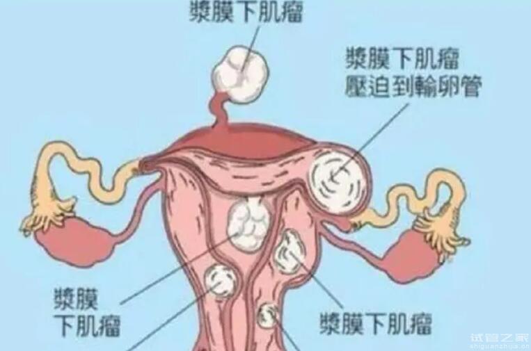 殘角子宮能治愈嗎做試管能成功嗎？