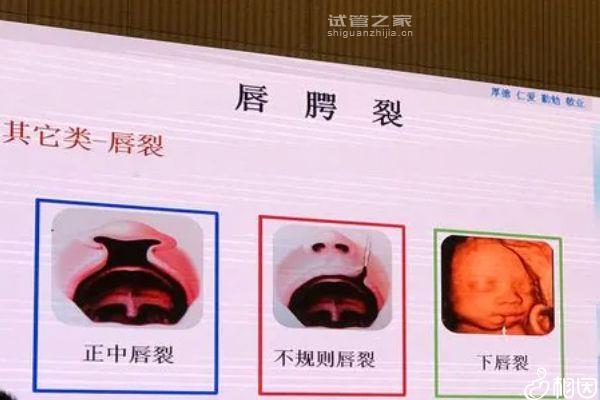 一文詳解2q13微缺失孩子能不能要，盲目留下危害真不小