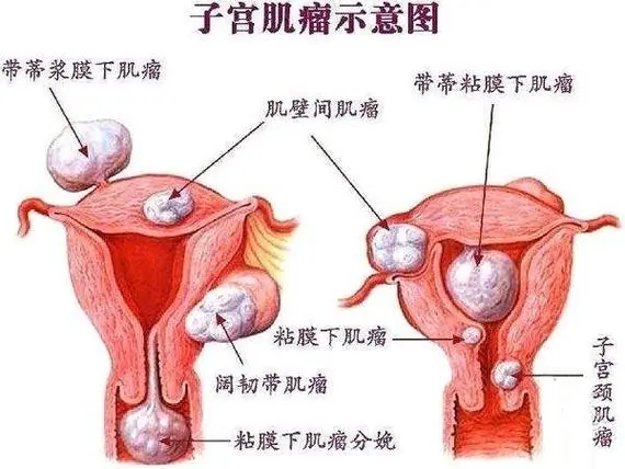 復(fù)雜性內(nèi)膜增生是癌嗎?子宮內(nèi)膜增生要切除嗎?