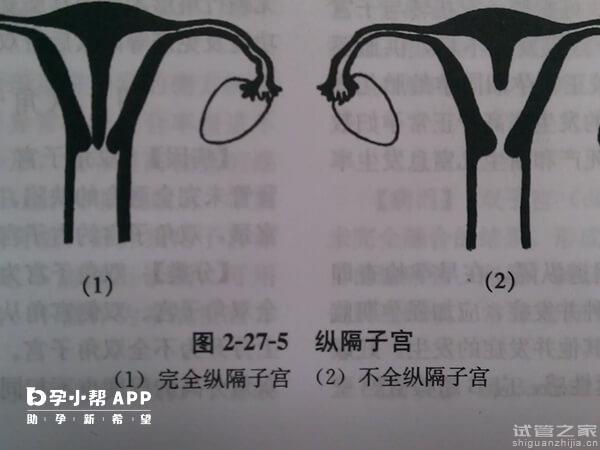 縱隔子宮能否正常懷孕生子？醫(yī)生：部分人妊娠風(fēng)險(xiǎn)較大