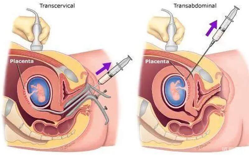 淺談絨毛穿刺檢查全過(guò)程，從掛號(hào)到傷口處理，一文通！