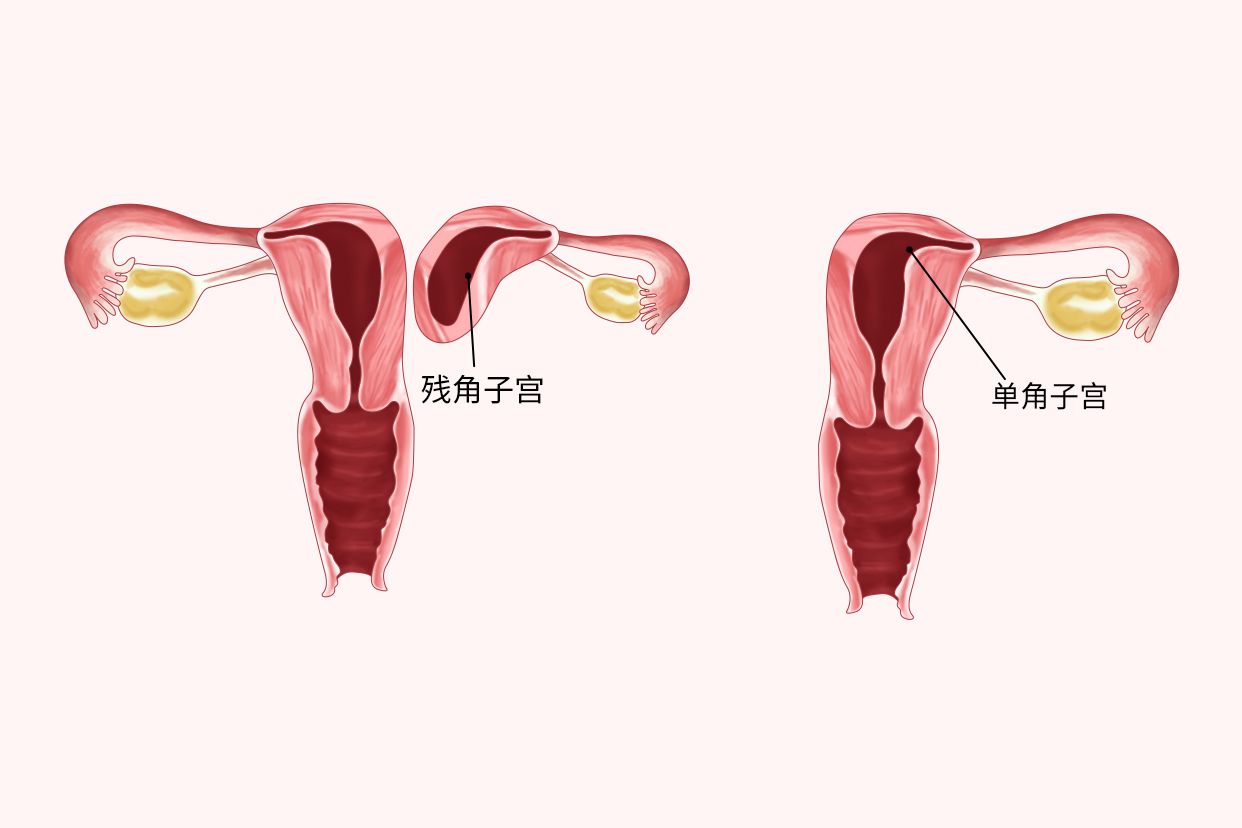 單角子宮合并殘角子宮可以做試管嗎，附解決措施及成功幾率解讀 ...