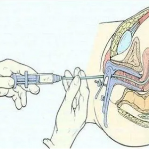 人工授精分為幾種？人工授精手術(shù)后的術(shù)后注意事項