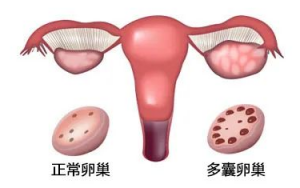 多囊*巢綜合征的正確理解姿勢-歐洲和中國多囊*巢綜合征的診斷標準 