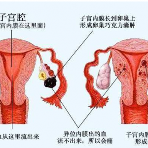 子宮內(nèi)膜異位患者可通過泰國試管嬰兒受孕嗎？