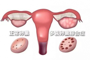 多囊患者做試管嬰兒前要“減肥”嗎？