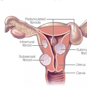 子宮肌瘤會影響試管嬰兒治療么？
