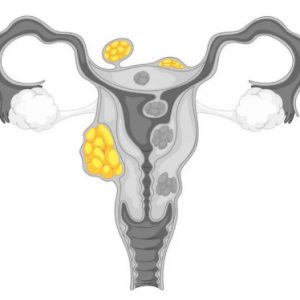 患有子宮肌瘤對做試管嬰兒有多大的影響?