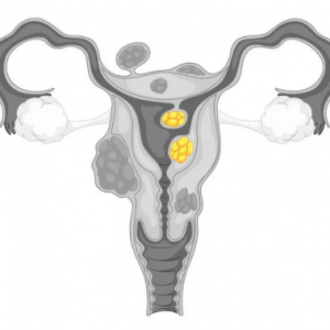 子宮肌瘤會影響試管嬰兒成功率嗎？該怎么處理？