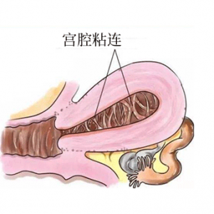 帶你了解宮腔粘連