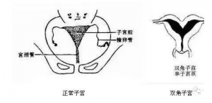 鞍型子宮可以做試管嬰兒嗎，要注意什么？